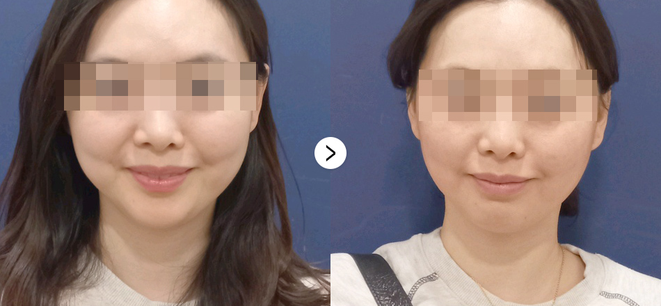 케이톡스 전후사진