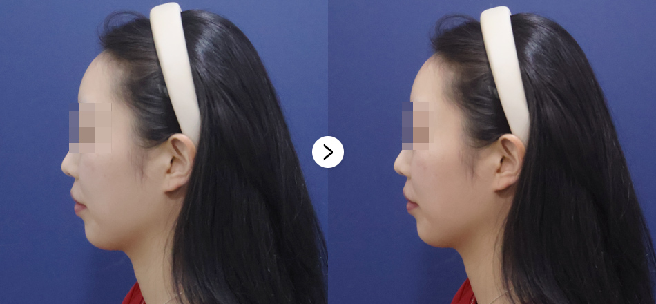 케이톡스 전후사진