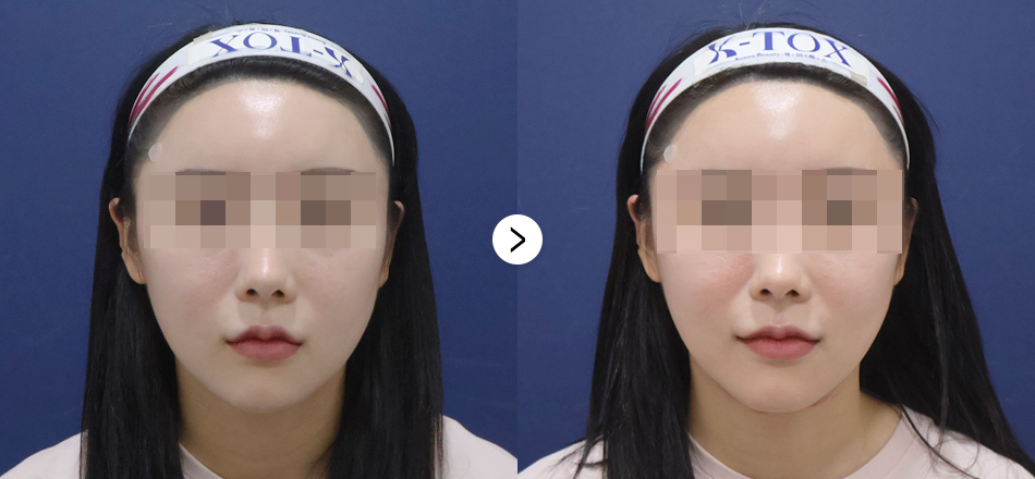 케이톡스 전후사진
