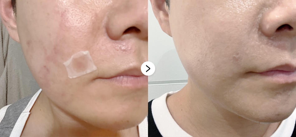 케이톡스 전후사진