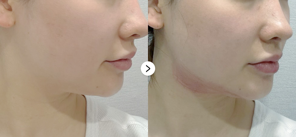 케이톡스 전후사진