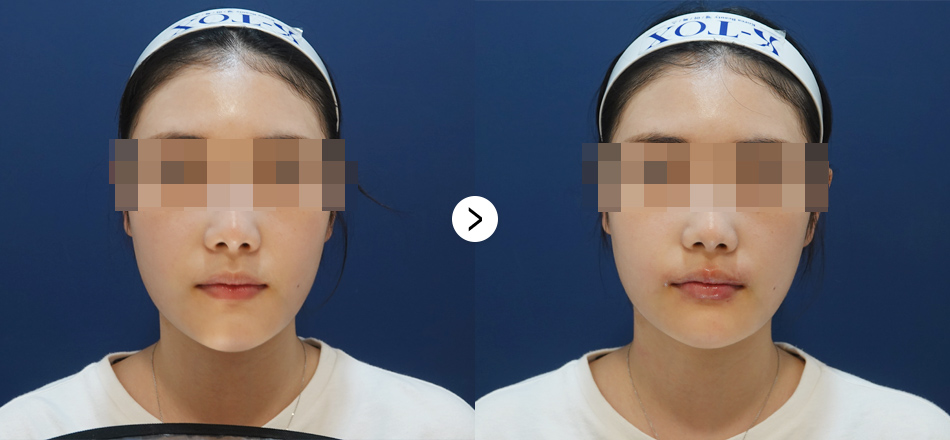 케이톡스 전후사진