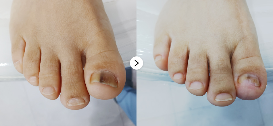 케이톡스 전후사진