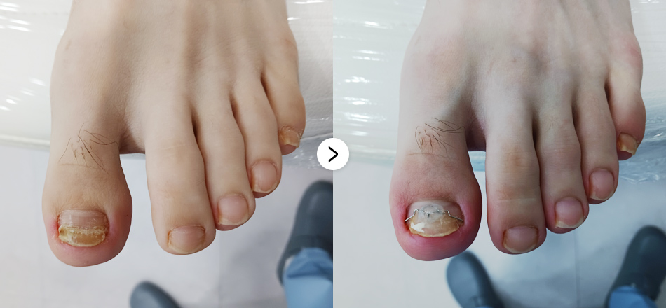 케이톡스 전후사진