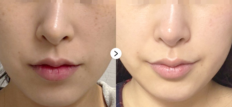 케이톡스 전후사진