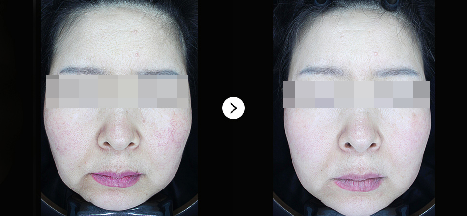 케이톡스 전후사진