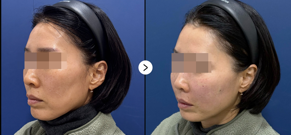 케이톡스 전후사진