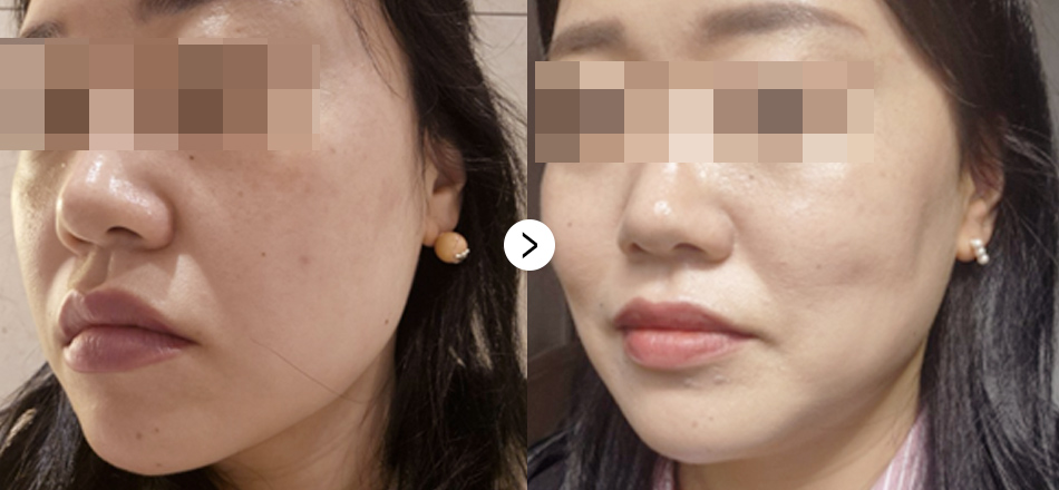 케이톡스 전후사진