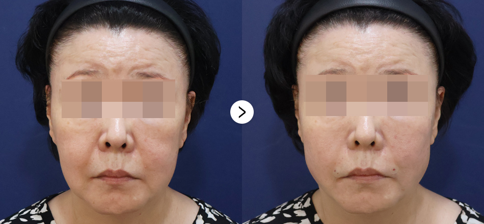 케이톡스 전후사진